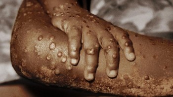साउदीबाट फर्किएका अर्का व्यक्तिमा पनि देखियो मंकीपक्स